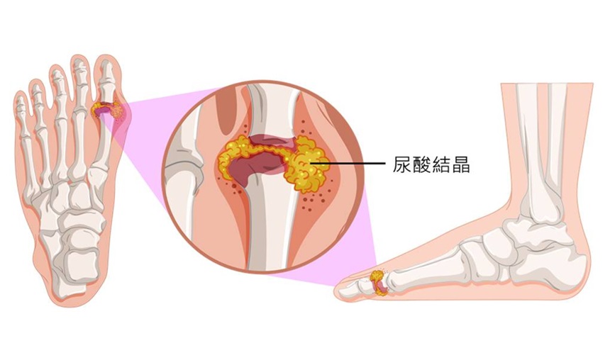 五种简单有效的消肿止痛方法，厨房里就有的神奇草药（网络图片）