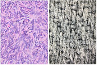 Woven or storiform: Elongated cells or nuclei wherein small bundles are aligned in an otherwise haphazard pattern.