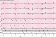 Blocco atrioventricolare di II grado (Mobitz 1, periodismo di Luciani-Wenckebach): si caratterizza per il progressivo allungamento del PR fino a che un complesso QRS viene a mancare (cioè una onda P non è seguita dal complesso QRS). Le linee verticali 1 e 3, indicano il PR allungato, la 2° l'assenza del QRS.