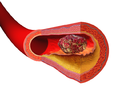 Ilustración que mostra a formación dun trombo sobre unha placa arterial.