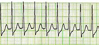 Tachicardia parossistica sopraventricolare: è un ritmo cardiaco ad alta frequenza, che origina al di sopra del ventricolo. Non sono visibili le onde P e la frequenza è in genere superiore ai 150 batt/min.