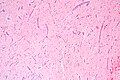 Atrial myxoma. H&E stain.