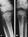 Radiografies de metàstasis bilaterals d'un neuroblastoma a la porció inferior dels fèmurs i superior de les tíbies.