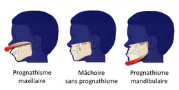 Description de l'image Prognathism3-fr.png.