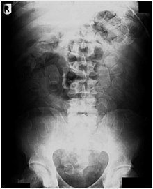 Radiografia di un addome pieno di cocaina.