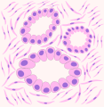 Rappresentazione B Adenocarcinoma: la presenza di strutture ghiandolari più o meno differenziate testimonia la natura della neoformazione.