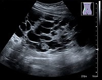 Figure 7. Advanced polycystic kidney disease with multiple cysts.[1]