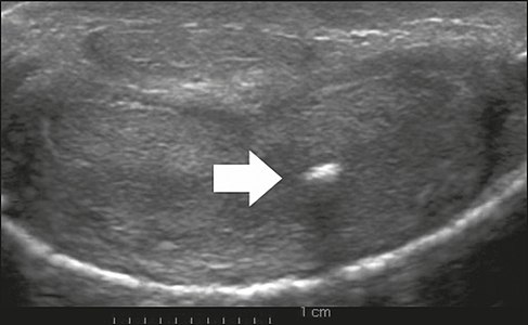 Figure 6: Transverse ultrasound of the penis, in a ventral view, in the middle portion of the penis. Note the echoic image with posterior acoustic shadowing, corresponding to calcification (arrow), in the left corpus cavernosum.[1]