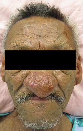 Rhinophyma