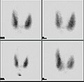 Thyroid scan with iodine-123 for evaluation of hyperthyroidism.