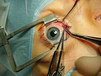 Strabismus surgery