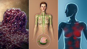 3D medical illustration depicting the TNM stages in breast cancer