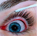 Thumbnail for Conjunctivitis