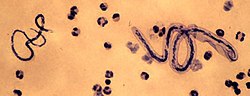 Miniatyrbilete for Filariasis