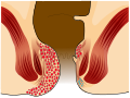 A grade IV hemorrhoid protrudes out of the anus.