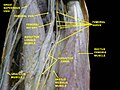 Femoral artery - deep dissection.