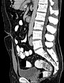 A tomografia computadorizada (reconstrução sagital) que mostra o Úraco achado incidental em um homem de 44 anos de idade, a trajetória se move para frente e para cima a partir da bexiga para o umbigo na linha média.