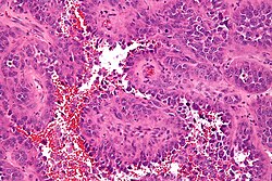 Epithelioid angiosarcoma - high mag.jpg