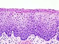 Neoplasia cervical intraepitelial 6533 visitas en sept de 2010