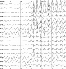 Epilepsziás rohamra jellemző tüske-hullámok egy beteg EEG vizsgálata során.