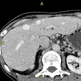 Axial CT image showing anomalous hepatic veins coursing on the liver's subcapsular anterior surface[74]