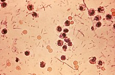 Shigella dysenteriae ve vzorku stolice