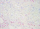 Gram stain of a muscle biopsy showing Gram-positive, rod-shaped, anaerobic, spore-forming bacteria in the infected muscle tissue: The result is highly compatible with an infection with C. perfringens.