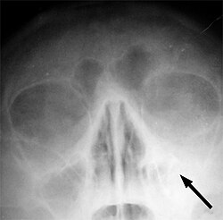 דלקת בגת הלסת (Maxillar sinusitis) השמאלית; הגודש נראה בצבע לבן