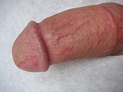 Inflammation of the glans penis and the preputial mucosa.jpg