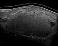 Fig. 6 Ultrasonography of a liposarcoma mimicking a lipoma. This homogeneous high-echoic mass has the same appearance as a lipoma.[69]