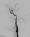 DSA snímek - Angiogram arteria carotis interna