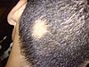 Alopecia areata (fläckvis håravfall)