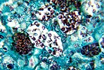 Miniatura para Histoplasmosis