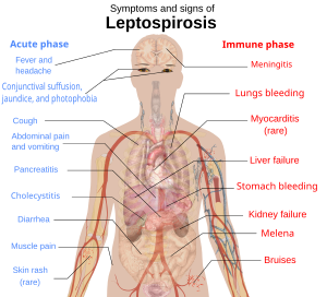 A schematic of the human body showing the symptoms and signs of leptospirosis