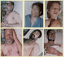 Iranian victims of the Iraqi chemical attack on Sardasht