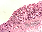 Adenokarcinom želuca i intestinalna metaplazija (boja H&E)