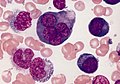 Acute erythroid leukemia, a rare form of acute myeloid leukemia