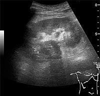 Figure 10. Solid tumor in the renal sinus seen as a hypoechoic mass, later found to be lymphoma. The '1' and '2' on the US image are reference points used for CT fusion (not shown).[1]