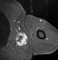 Fig. 7 MRI of myxoid liposarcoma of high grade, in the left axillary region of 40-year-old man, highlighted by its white color, in this horizontal section of the tumor.