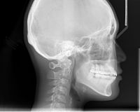 X-ray diambil untuk analisis tengkorak