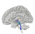 Medial lemniscus'u gösteren traktografi