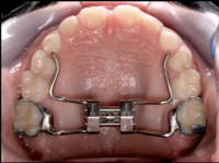 Pengembang Palatal