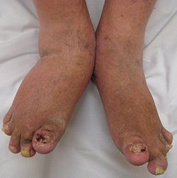 Psoriatic_arthritis2010.JPG