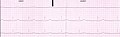 Kardiogramm 10 cm laiusel kardiograafipaberil