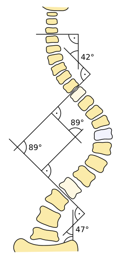 Cobb-fok mérése levoscoliosis esetén