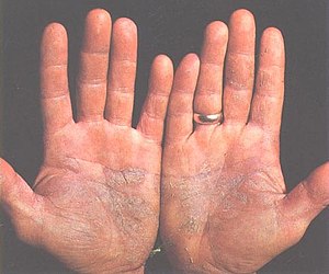 Psoriasis on a pair of hands. The disease can be caused by faulty JAK-STAT signalling.