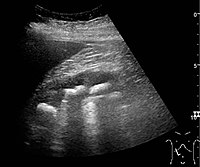 Figure 20. Staghorn calculi filling the entire collecting system and creating pronounced shadowing.[1]