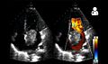 Echocardiogram showing atrial myxoma[9]