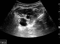 Figure 17. Same patient as in Figure 16 with measurement of the pelvis dilation in the transverse scan plane illustrated on the US image with ‘+’ and a dashed line.[1]