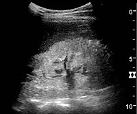 Figure 23. Nephrotic syndrome. Hyperechoic kidney without demarcation of cortex and medulla.[1]